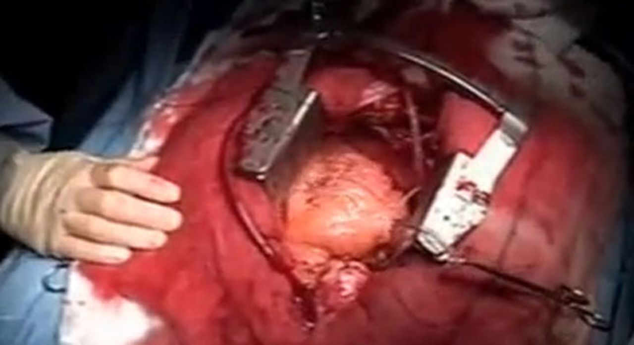 open-hart-operatie.jpg