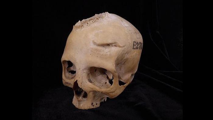 Chirurgie aan de schedel in het oude Egypte