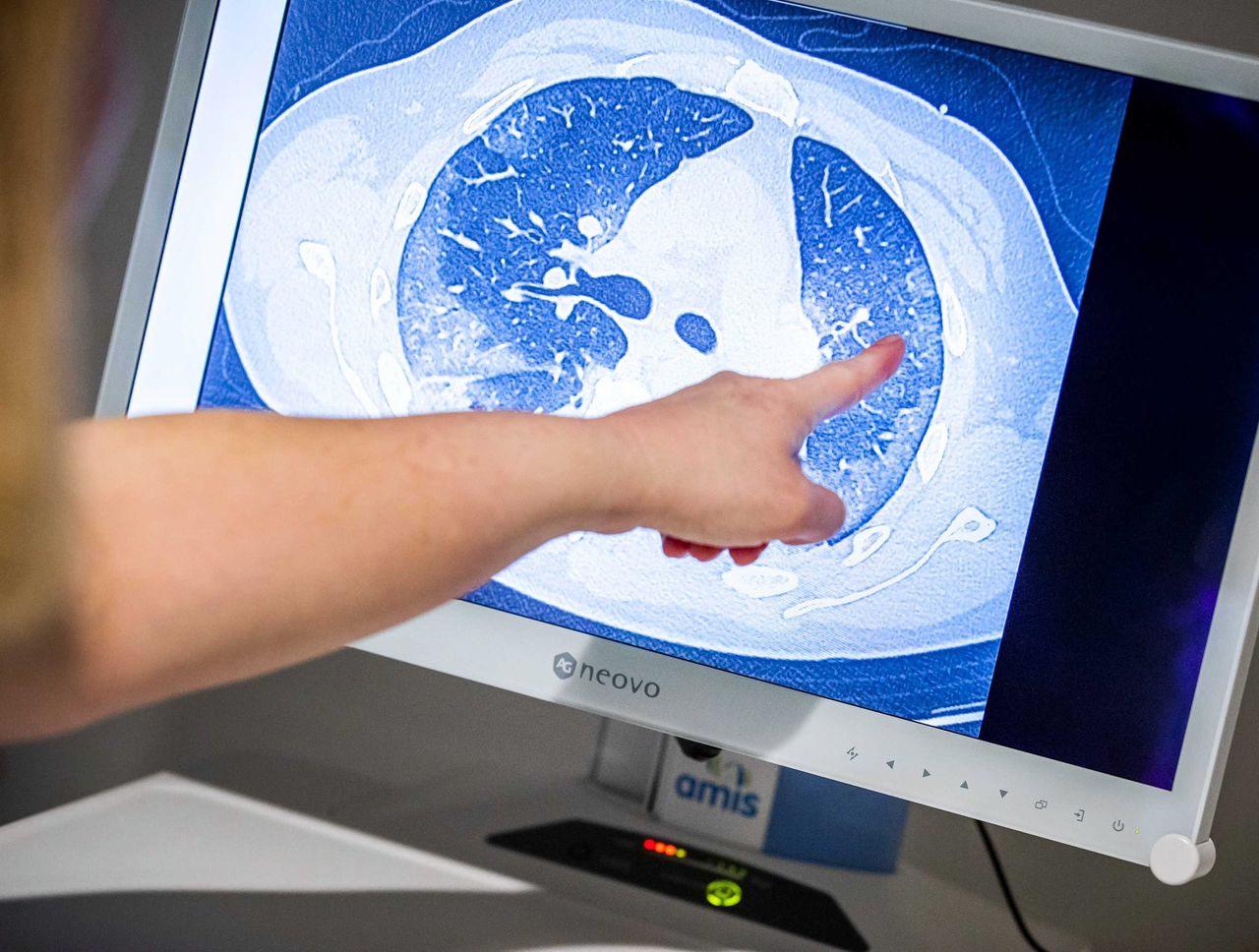 Een arts van het HMC Westeinde ziekenhuis kijkt naar een CT-scan van de longen van een coronapatiënt.