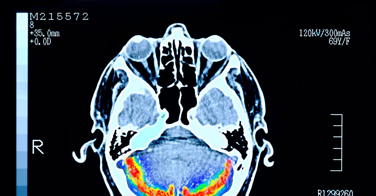 Een voorspelmodel voor alzheimerpatiënten vertelt iets meer over hoe het verder gaat met hun ziekte