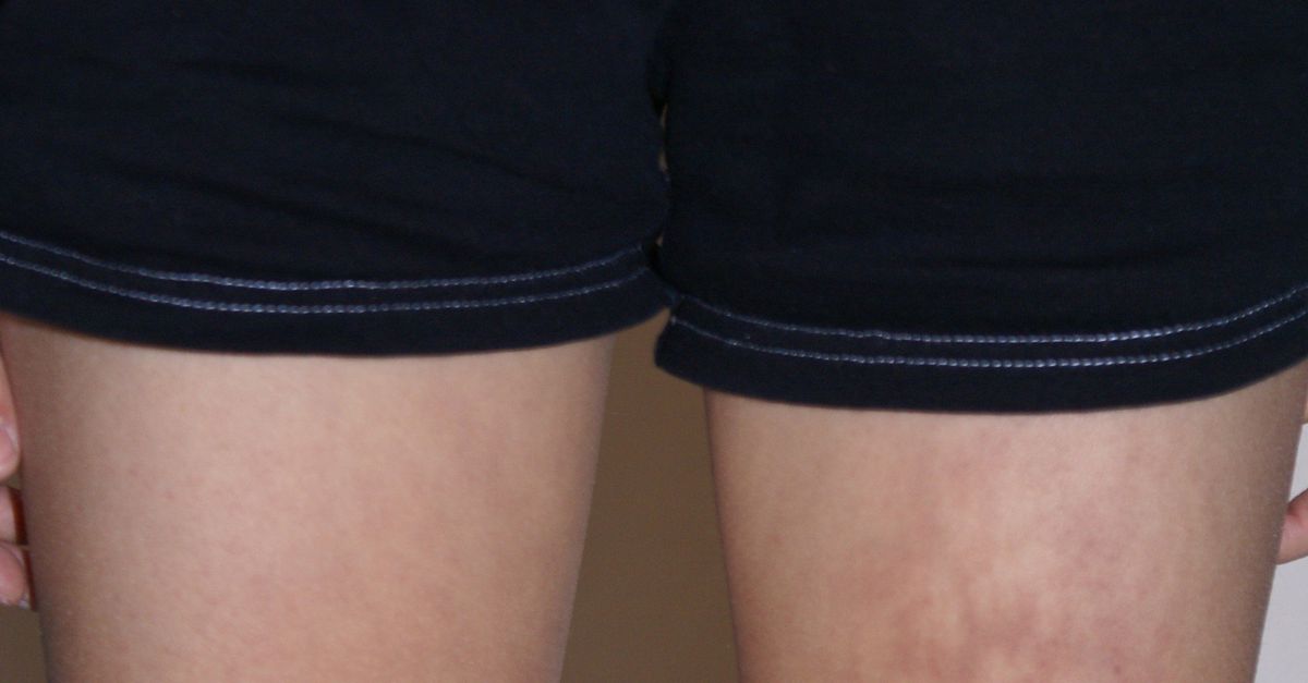 Pas op! Toasted skin syndrome NRC