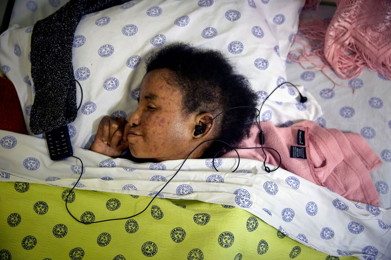 Een vrouw is opgenomen in een Mozambikaans ziekenhuis nadat ze thuis ’s nachts in bed meerdere keren was gebeten door een cobra. Ze hield er een ernstige voetwond aan over (foto beneden).