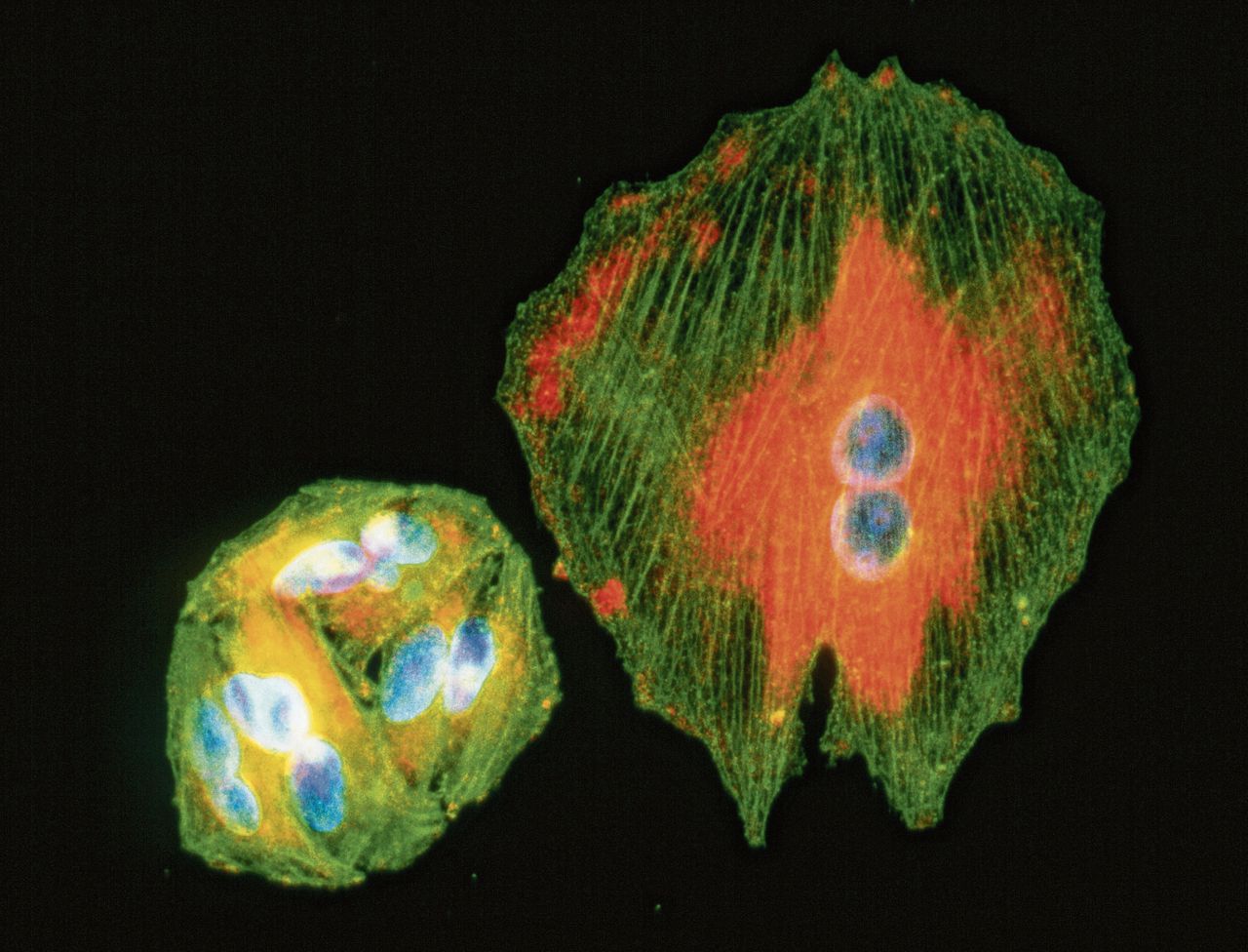Gekweekte melanoomcellen onder de lichtmicroscoop, gekleurd met fluorescente stoffen – links delende cellen, rechts een grote cel met twee celkernen.