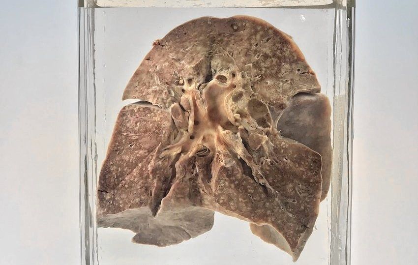 De longen van een in 1912 overleden tweejarig meisje. De onderzoekers slaagden erin hieruit mazelenvirus te isoleren.