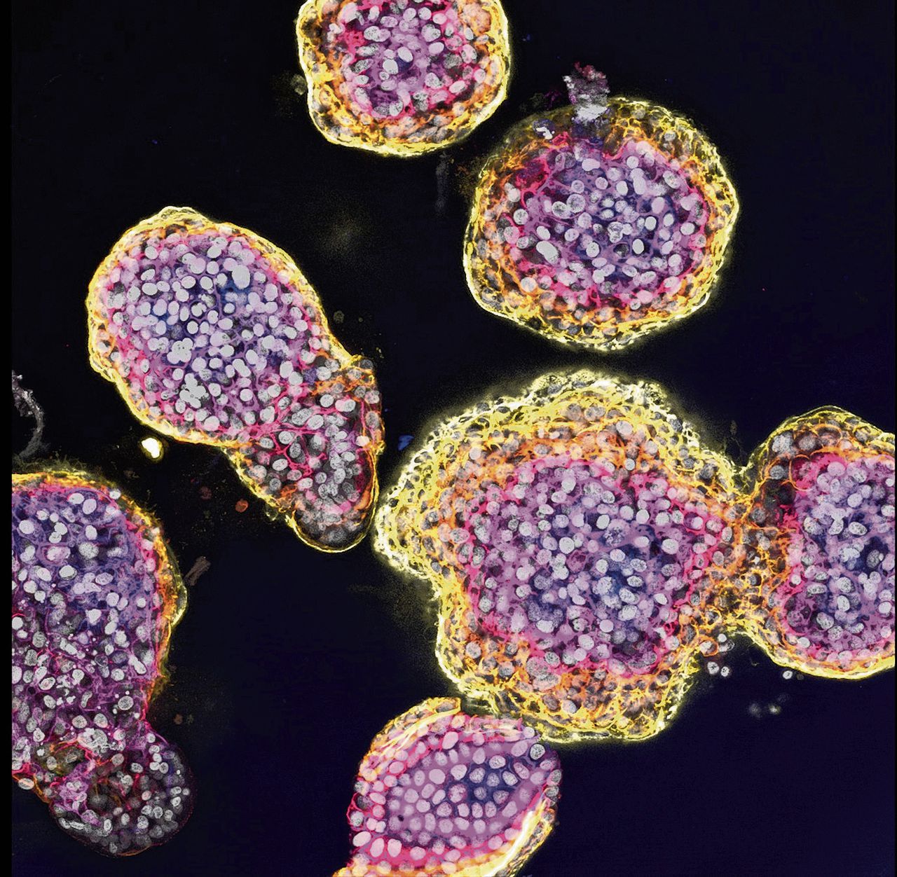 Tumorgroei in menselijke minilevers 