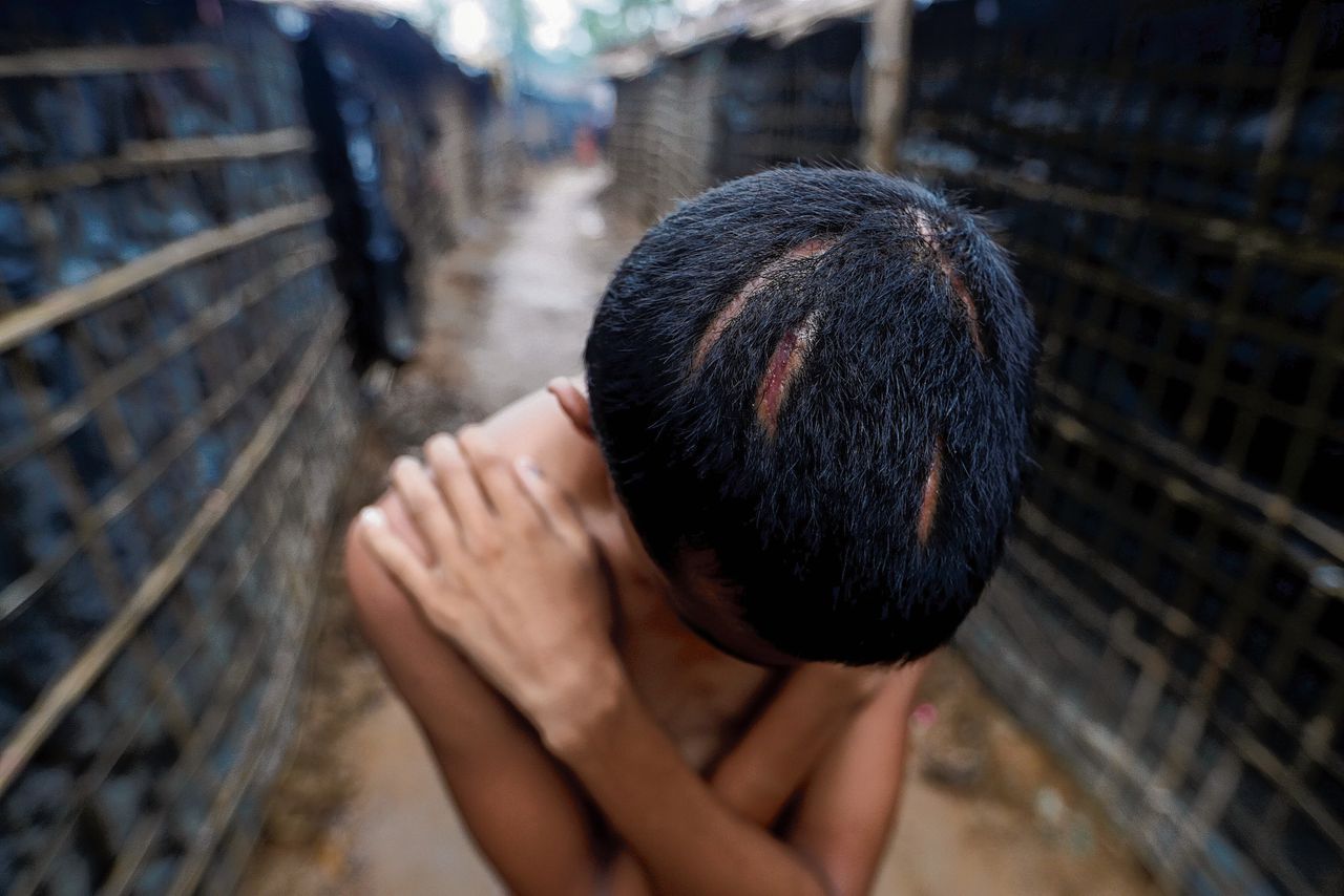 Een 17-jarige gevluchte Rohingya toont de verwondingen die Birmese militairen hem toebrachten. Zijn vlucht samen met een oom naar Bangladesh duurde twee weken. Nu vragen zij de internationale gemeenschap om hulp. In het boeddhistische Birma worden de islamitische Rohinya beschouwd als indringers.