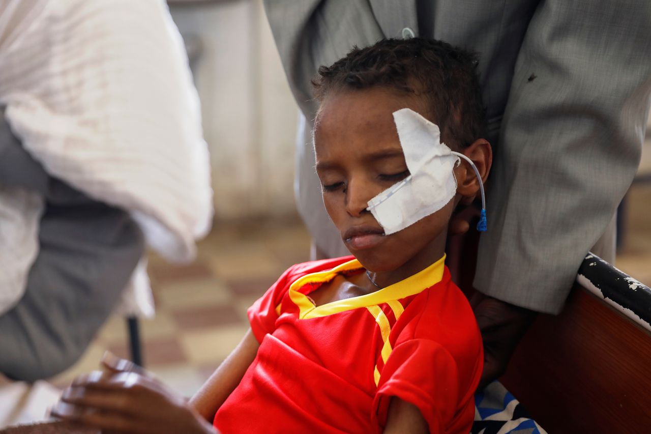 Een ondervoed jongetje in een ziekenhuis in Tigray.