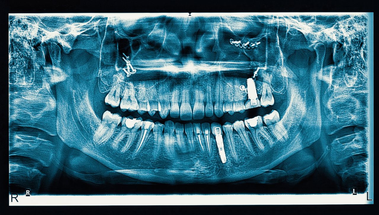 Röntgenfoto waarop twee schroeven in de kaken duidelijk zichtbaar zijn.