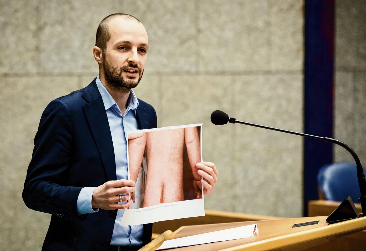 SP-Kamerlid Maarten Hijink toont een foto van iemand met de mazelen tijdens het Kamerdebat over vaccinatie.