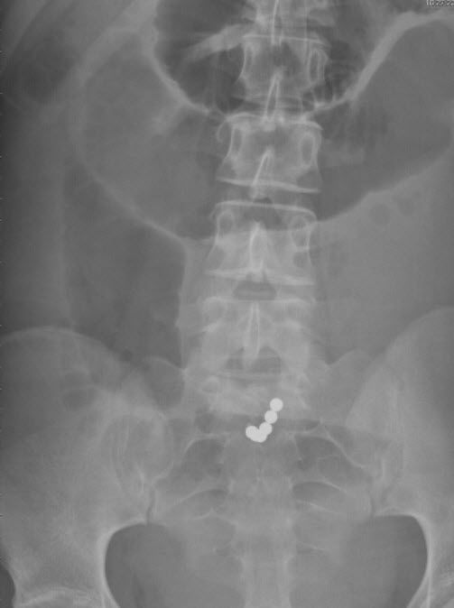 Piercing Die Gaten In Je Darm Maakt Nrc