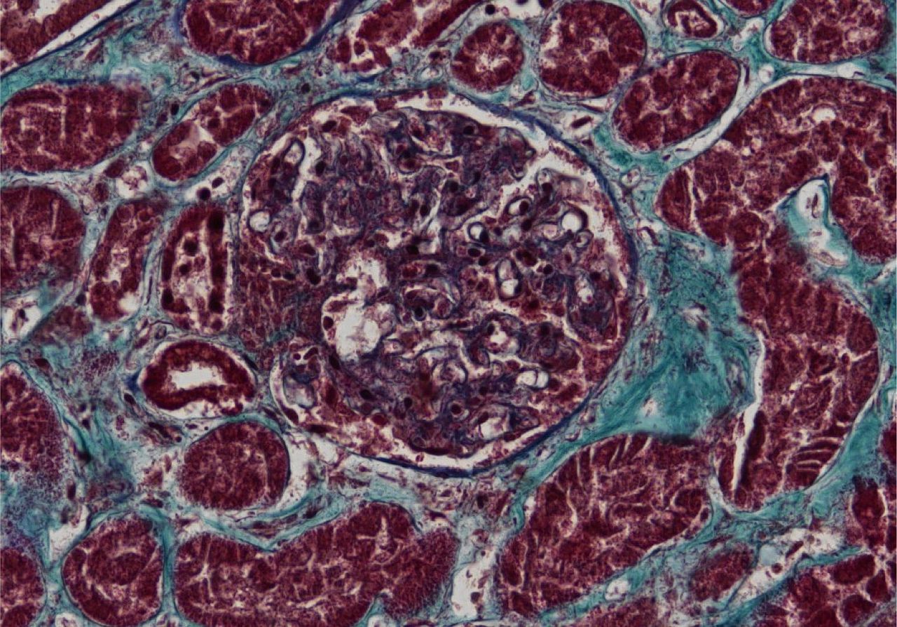 Nierweefsel van een overleden coronapatiënt met nierschade. Rood: niercellen. Blauw: littekenweefsel.
