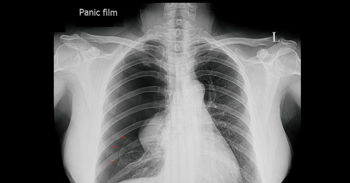 Hoe plak je een klaplong?