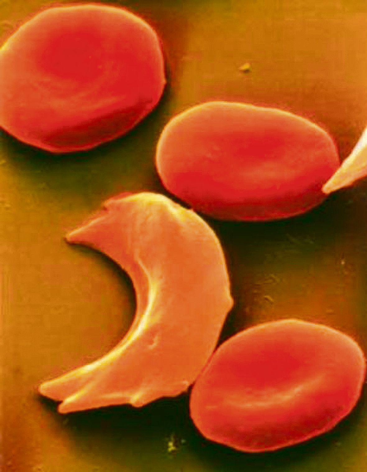 Ген серповидноклеточной анемии