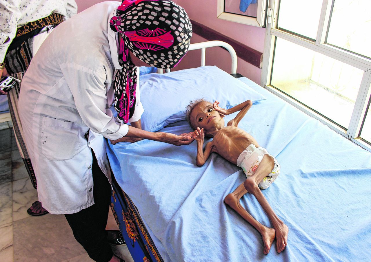 Een ondervoed kind in een ziekenhuis in Jemen.