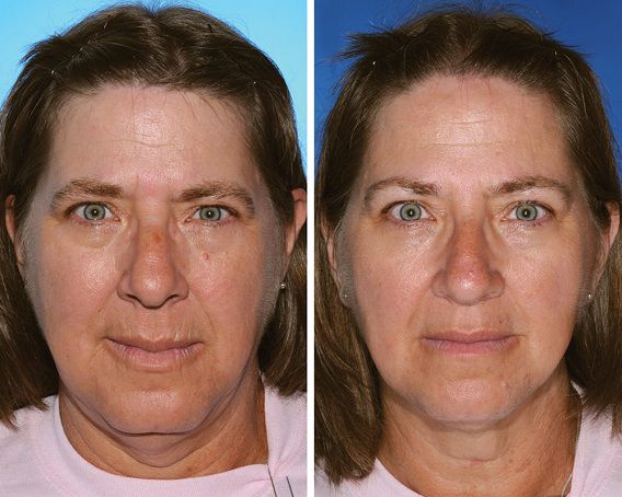 nicotinevlekken huid