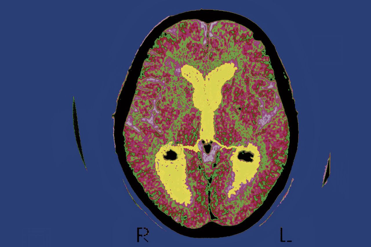 Er vallen gaten in het alzheimeronderzoek