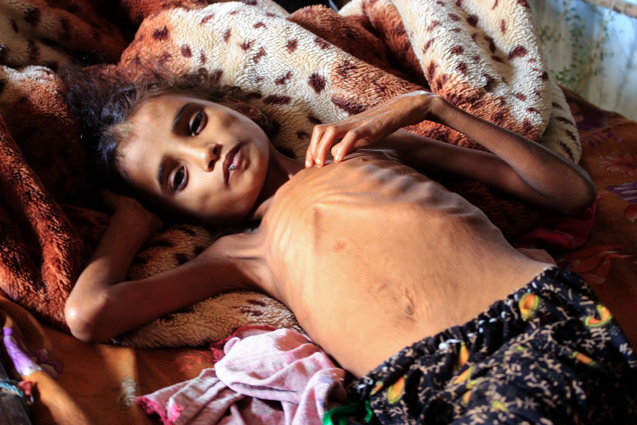 Een 10-jarig kind in Jemen dat minder dan tien kilogram weegt.