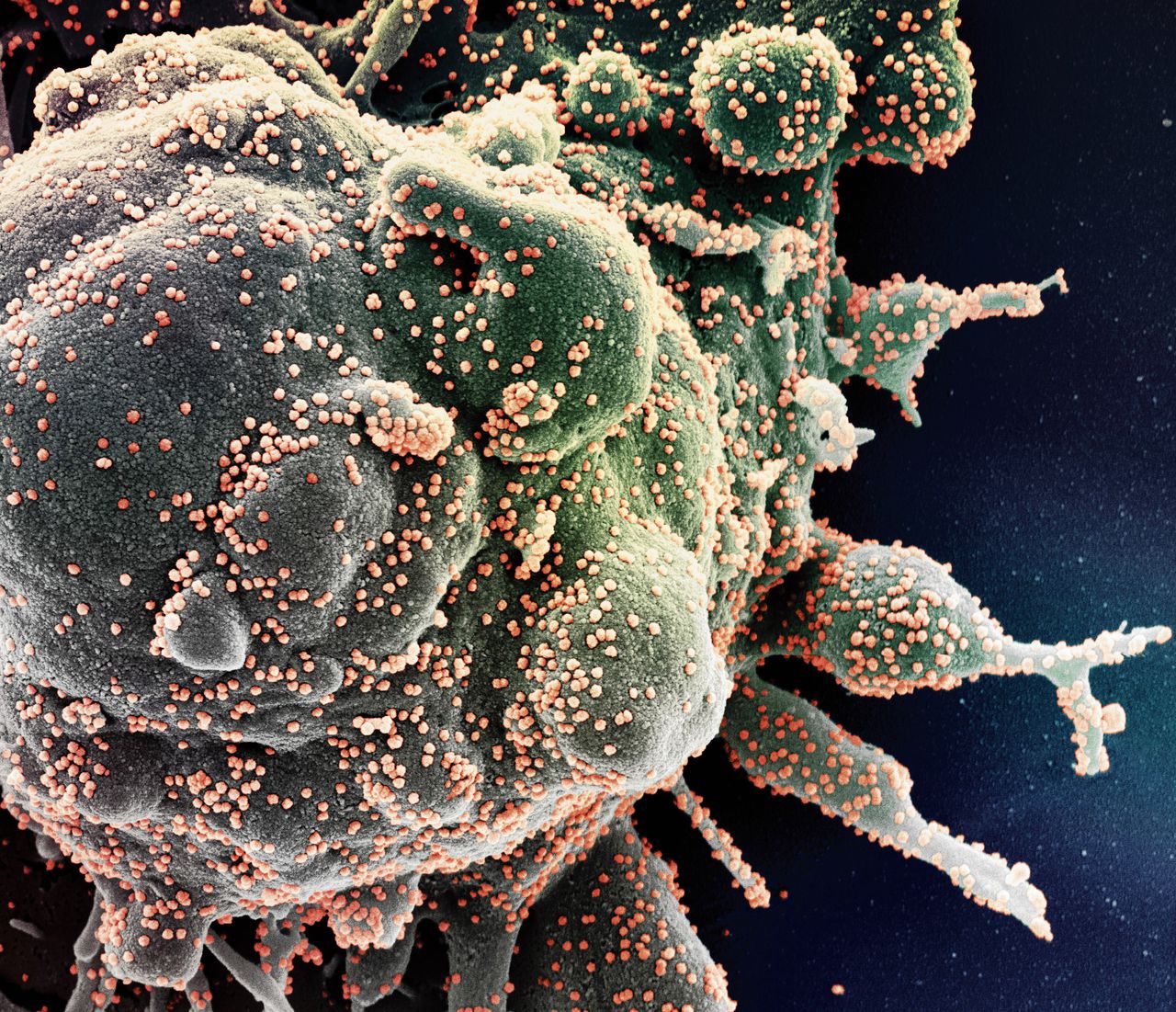 Ingekleurde elektronenmicroscopische foto van een cel (groen) die is geïnfecteerd met SARS-CoV-2 (roze bolletjes), geïsoleerd uit een Covid-19-patiënt.