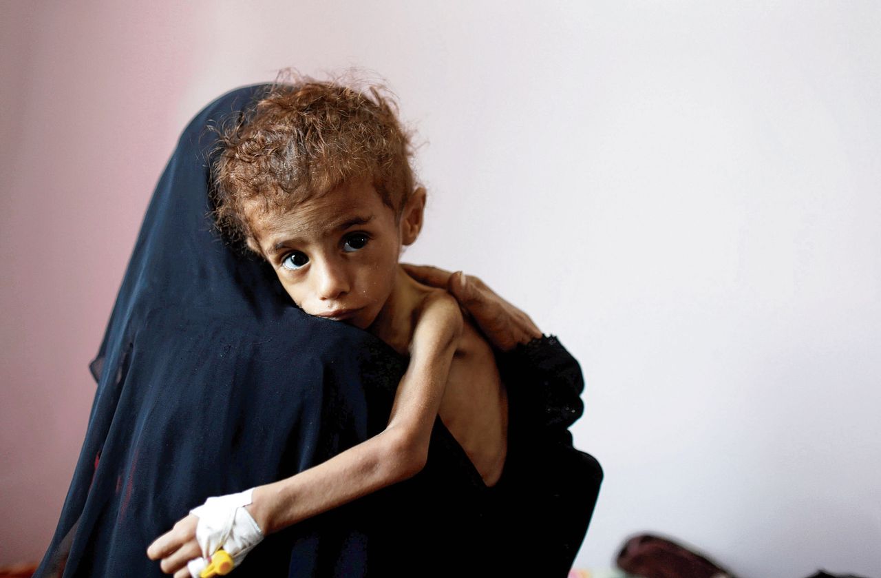 Een vrouw houdt een ondervoed kind vast in een ziekenhuis in Sana'a, Jemen