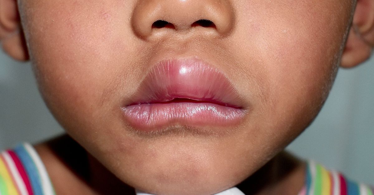 Genetic therapy cures hereditary angioedema thanks to dna-editing technique
