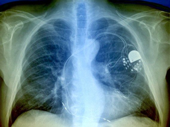 Röntgenfoto van de thorax met een pacemaker.