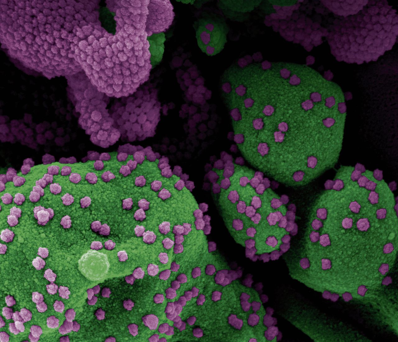 Virusdeeltjes (paars) ontsnappen uit cellen van een coronapatiënt.