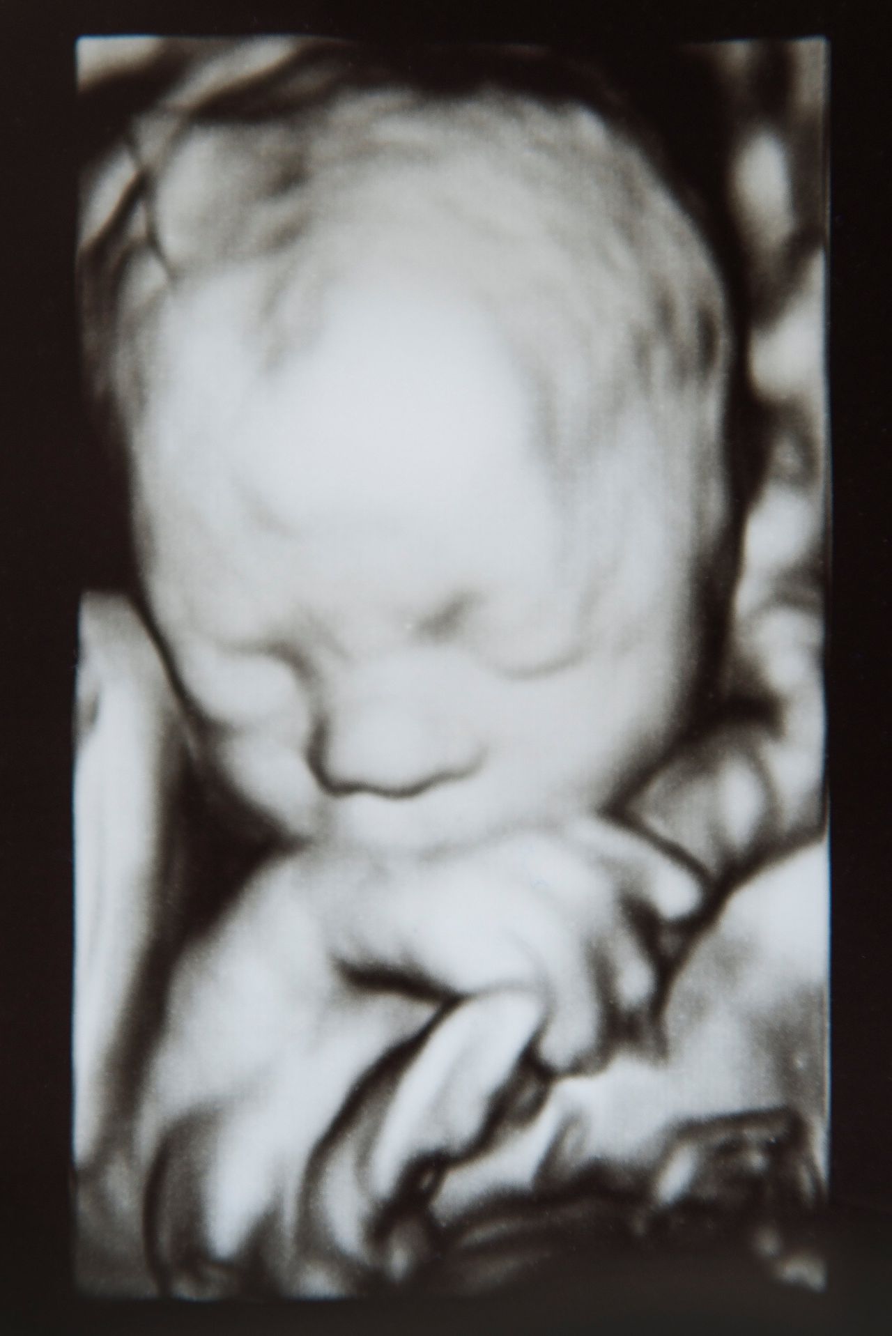 Foetus omklemt navelstreng.