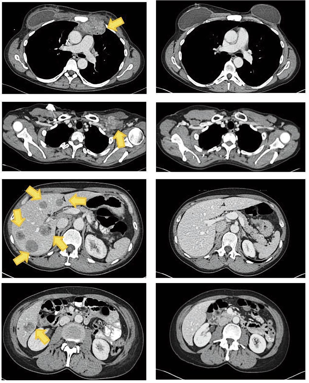 Uitzaaiingen van een borsttumor waren duidelijk te zien op scans (gele pijlen). Op beelden 22 maanden na de ingreep waren ze helemaal verdwenen.