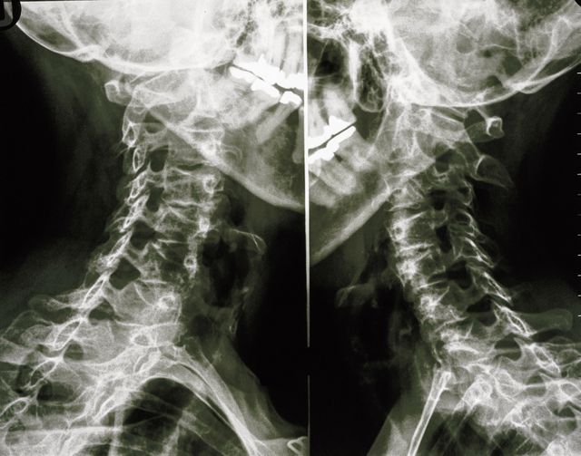 Herseninfarct na kraken van nek ‘Ik ben nog elke dag boos’ NRC