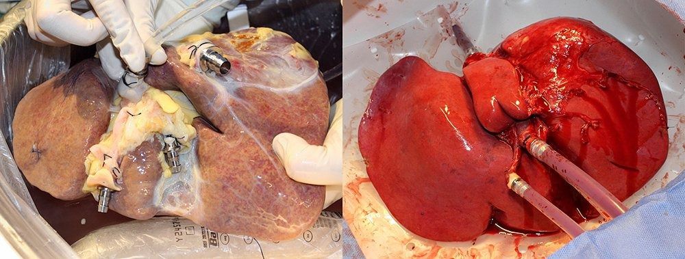 Links een niet-doorbloede lever. Rechts een lever die is aangesloten op de nieuwe ‘levermachine’.