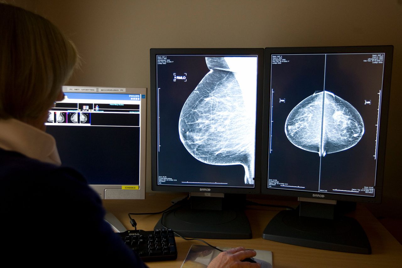De vijfjaars overlevingskans bij borstkanker (invasief) nam met 14 procentpunt toe.