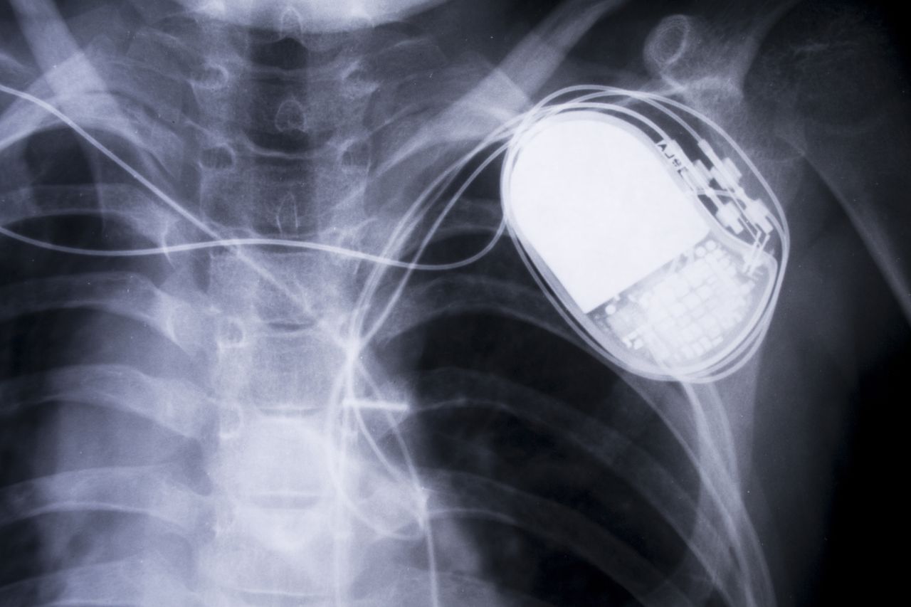 Een röntgenfoto van een pacemaker.