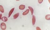 Microscopisch beeld van sikkelvormige rode bloedcellen bij een patiënt met sikkelcelziekte. 