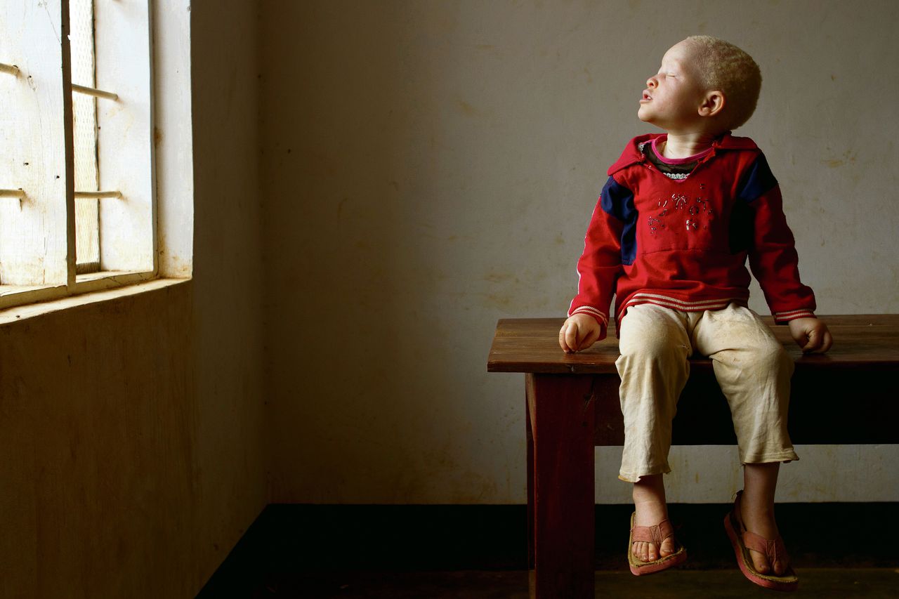 De foto’s tonen albino’s in een opvangcentrum in Kabanga, Tanzania. Van linksboven, met de klok mee: de 4-jarigeYonge, die door zijn ouders werd verlaten en nu wacht op adoptie.Musa (leeftijd onbekend) werd bij het opvangcentrum te vondeling gelegd. Hij zou uit een streek komen waar een levendige handel bestaat in lichaamsdelen van albino’s. Lightness Philbert (leeftijd onbekend) en ook een vondeling. Op zijn rug draagt hijJessica (drie maanden oud) die met haar moeder naar het centrum vluchtte uit angst aangevallen te worden in hun dorp. Deslaapzaal. EnJessica op de arm bij moederHelen.