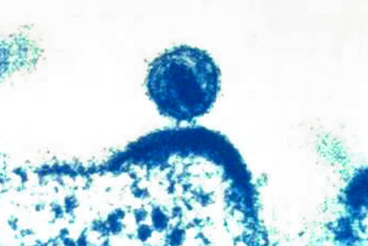 Een enkel humaan immunodeficiëntievirus (hiv) maakt zich los uit een geïnfecteerde immuuncel.