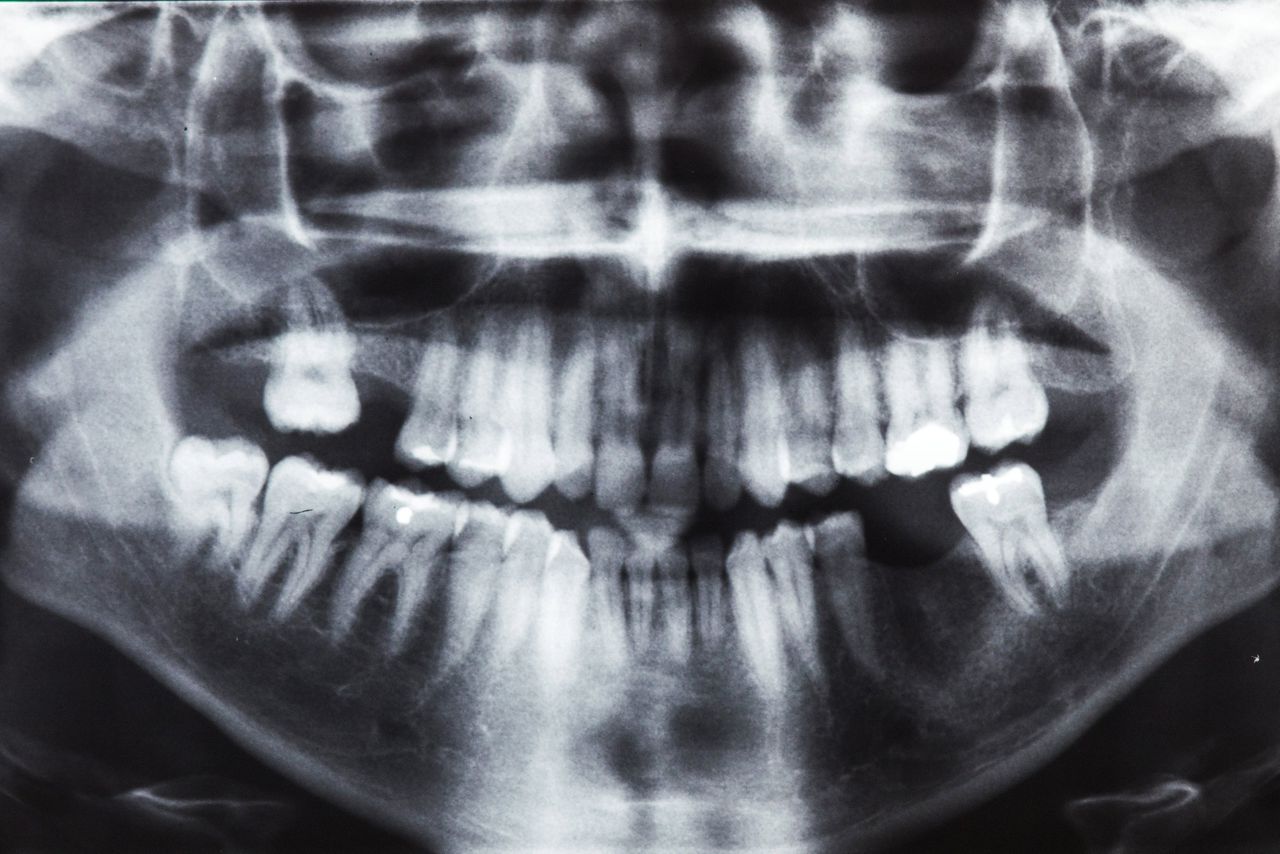 Een X-ray van een gebit