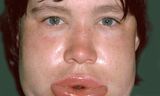 Un improvviso e doloroso gonfiore del viso può causare angioedema