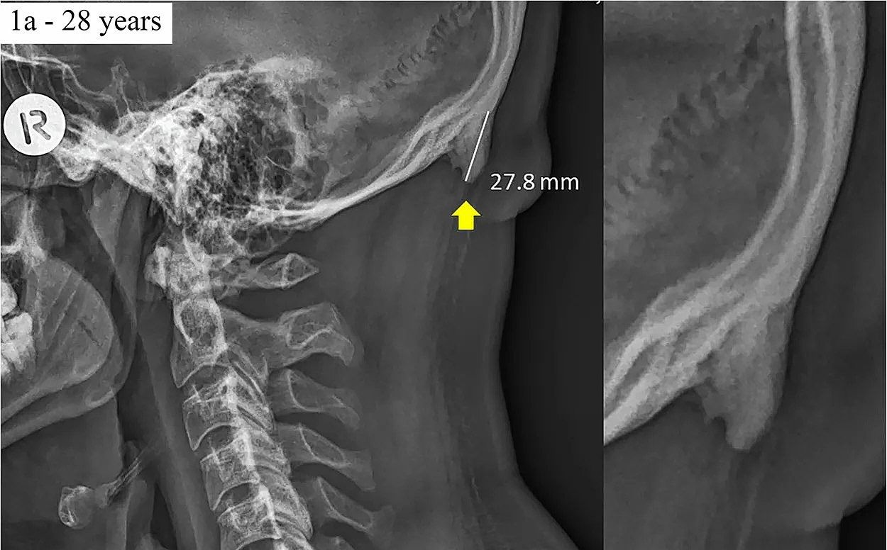 Röntgenfoto van de schedel van een 28-jarige man met een ‘hoorntje’.
