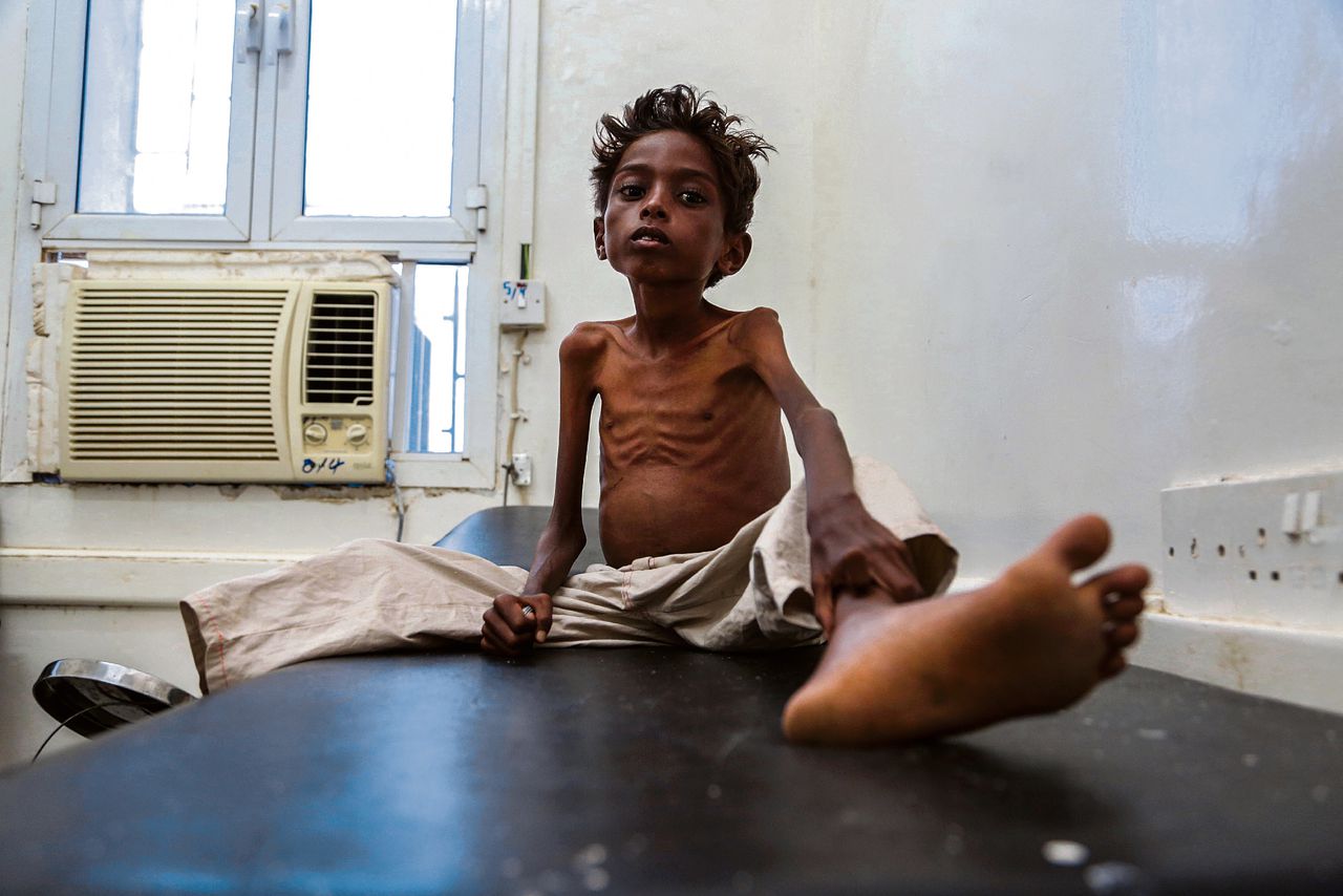 Half miljoen kinderen in Jemen dreigt te sterven 