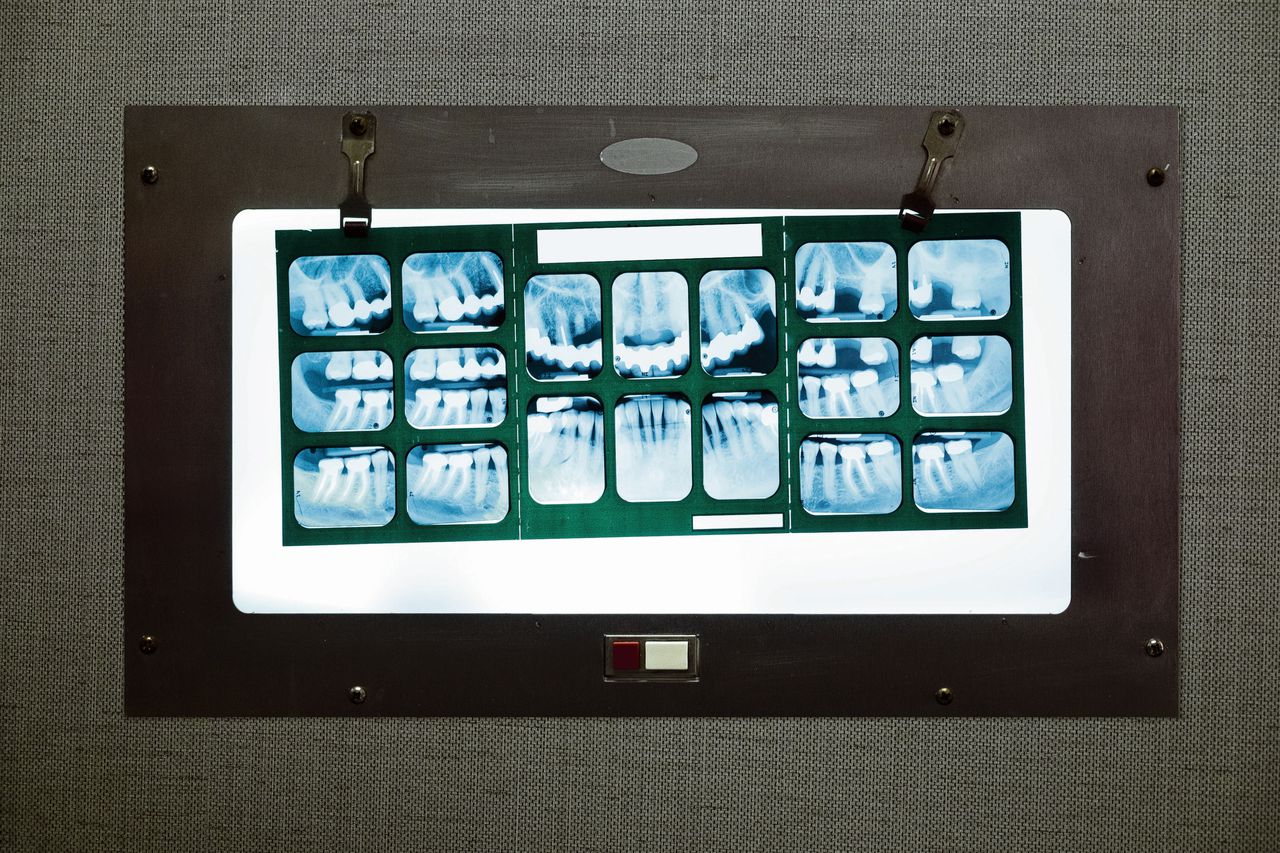 Röntgenfoto’s van een gebit. Een tandarts weet sinds de invoering van de nieuwe privacywet niet meer of hij die nog mag delen met de patiënt.