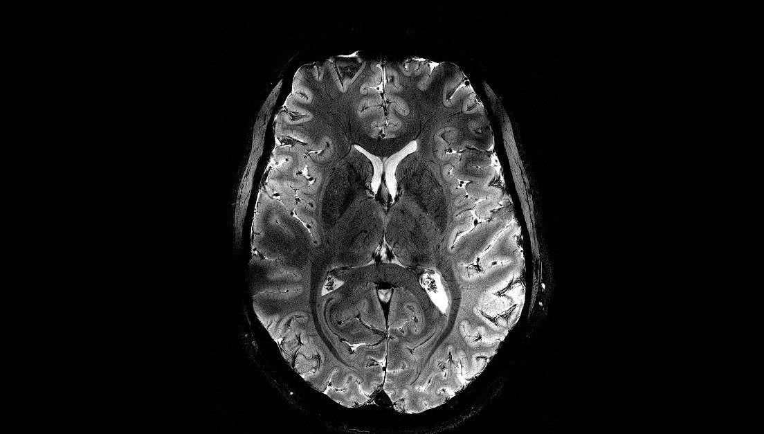 Un'immagine del cervello senza precedenti ottenuta da uno scanner MRI francese
