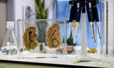 Een menselijk brein bij de Nederlandse Hersenbank. Links met kenmerken van de ziekte van Alzheimer.  