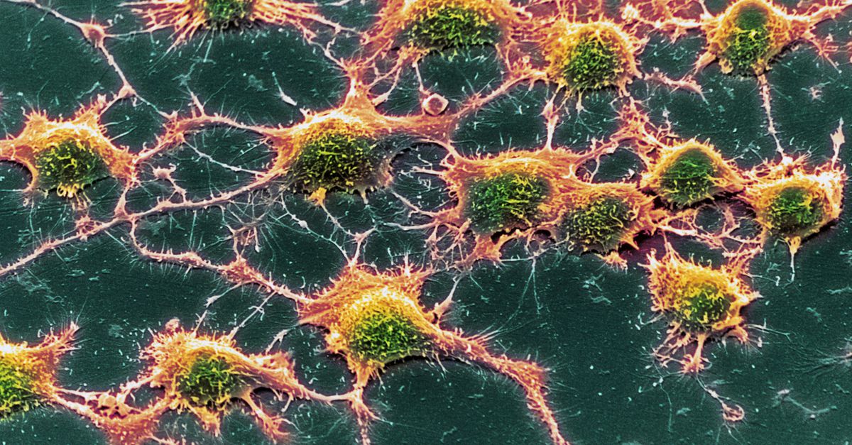 Wel klontjes in het brein maar geen alzheimer, hoe kan dat? Onrijpe hersencellen zijn mogelijk het antwoord