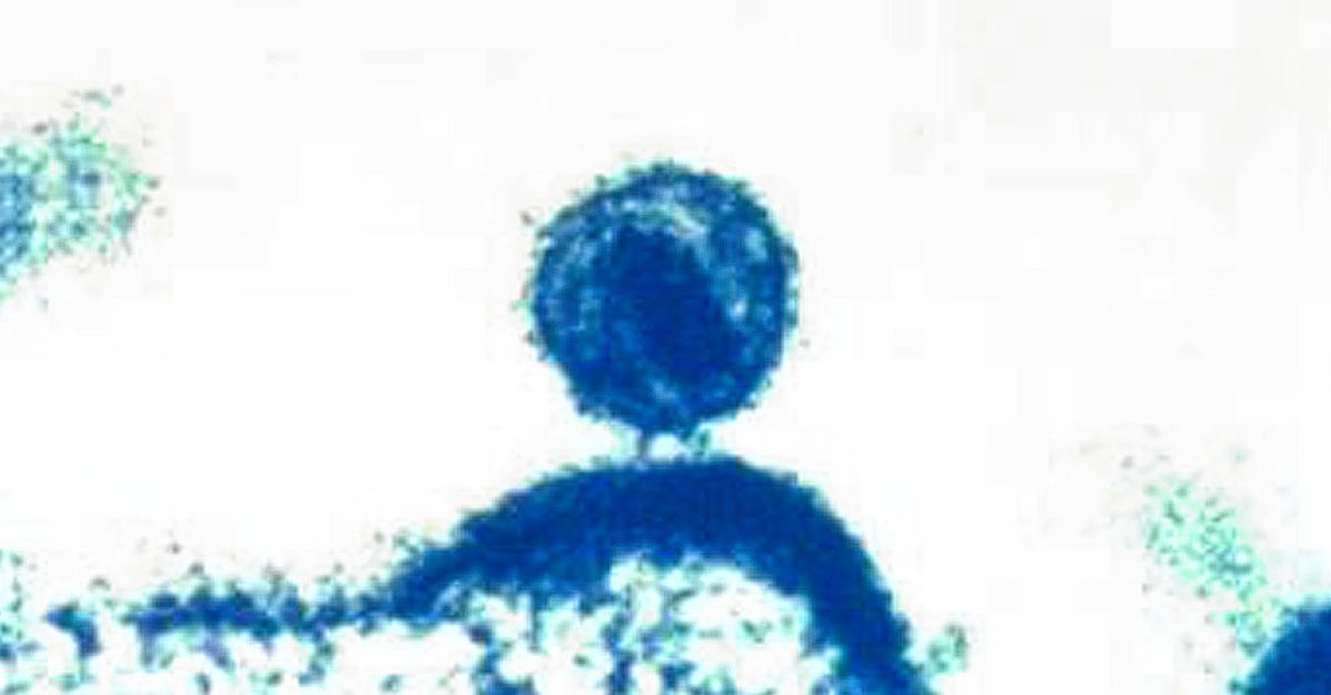 La donna guarisce dall’HIV grazie alle cellule staminali del cordone ombelicale