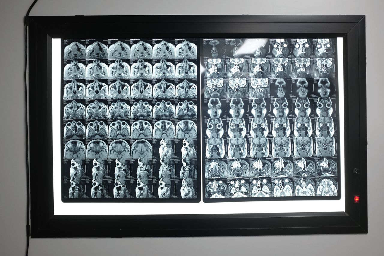 MRI-scan van een patiënt met zwarte schimmel