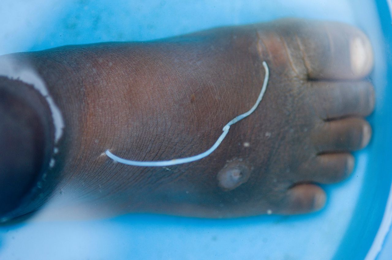Een guineaworm komt tevoorschijn uit de voet van een patiënt in Ghana.