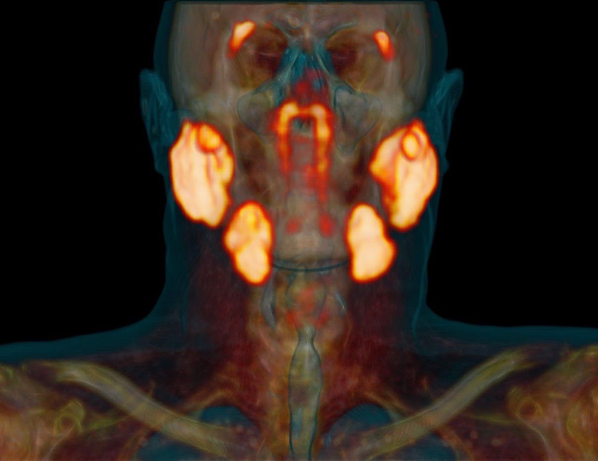 Scanbeeld van een patiënt waarop de grote speekselklieren en de traanklieren boven het oog oplichten. De nieuw ontdekte tubarialisklieren zijn zichtbaar in het midden ter hoogte van de neus.