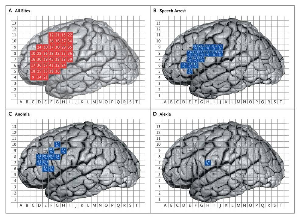 Mensen verliezen het vermogen om plaatjes te benoemen (anomia) bij het uitschakelen van delen van de hersenen. Individuele verschillen zijn zichtbaar door de verspreiding van de blauwe vakjes. Foto HH, beeld NEJM.